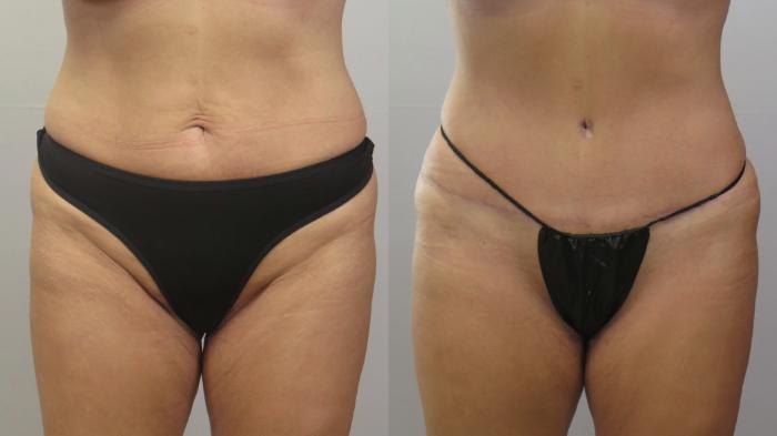 Tummy Tuck Case 1655 Before & After Front | Paramus, New Jersey | Parker Center for Plastic Surgery