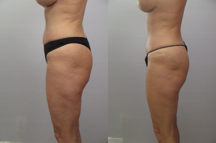 Tummy Tuck Case 1655 Before & After Left Side | Paramus, New Jersey | Parker Center for Plastic Surgery