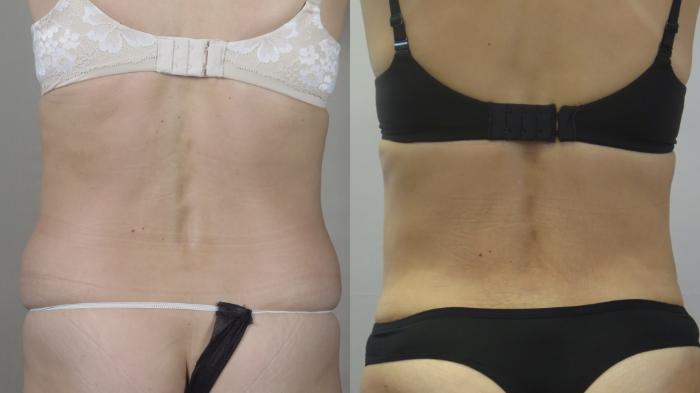 Tummy Tuck Case 1658 Before & After back | Paramus, New Jersey | Parker Center for Plastic Surgery