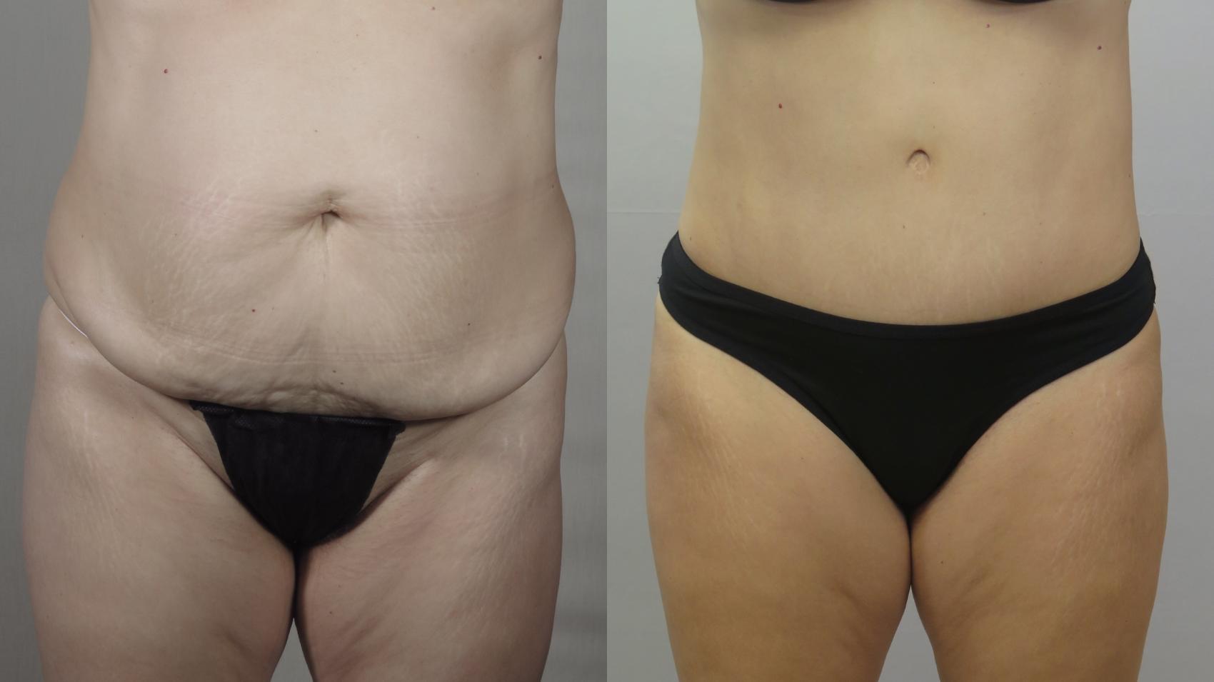 Tummy Tuck Case 1658 Before & After Front | Paramus, New Jersey | Parker Center for Plastic Surgery