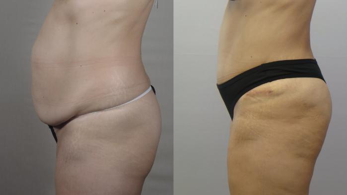 Tummy Tuck Case 1658 Before & After left side 1 | Paramus, New Jersey | Parker Center for Plastic Surgery