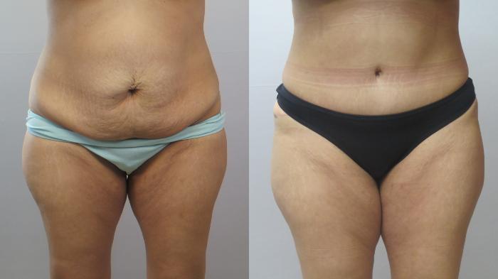 Tummy Tuck Case 1660 Before & After Front | Paramus, New Jersey | Parker Center for Plastic Surgery