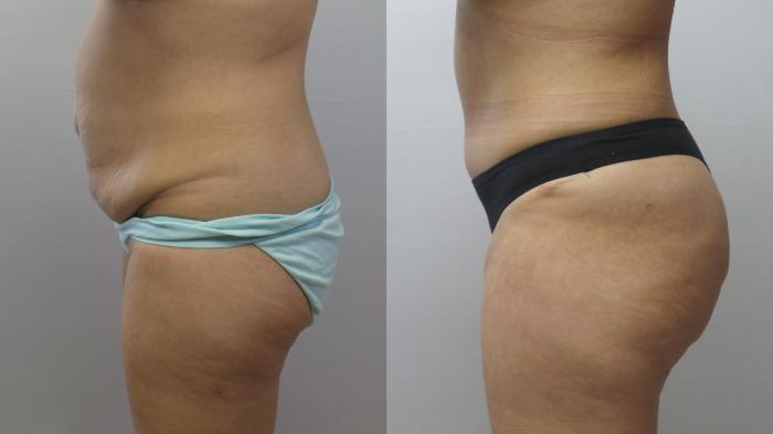 Tummy Tuck Case 1660 Before & After Left Side | Paramus, New Jersey | Parker Center for Plastic Surgery