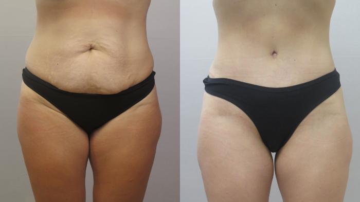 Tummy Tuck Case 1661 Before & After Front | Paramus, New Jersey | Parker Center for Plastic Surgery