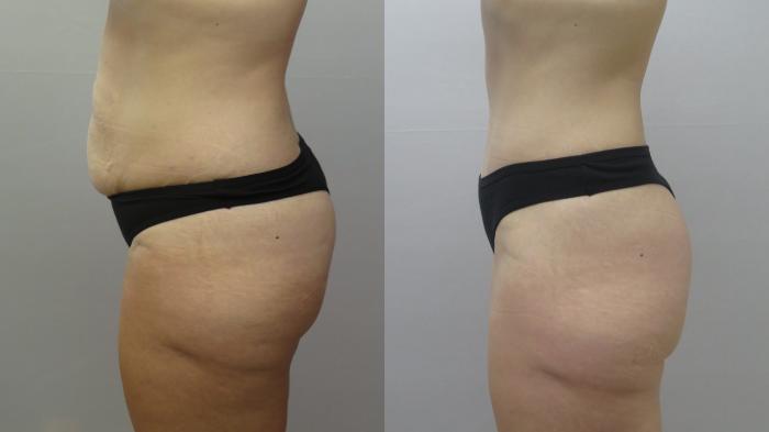 Tummy Tuck Case 1661 Before & After Left Side | Paramus, New Jersey | Parker Center for Plastic Surgery