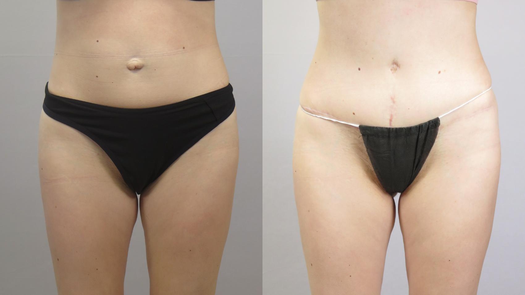 Tummy Tuck Case 1664 Before & After Front | Paramus, New Jersey | Parker Center for Plastic Surgery