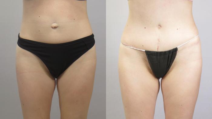 Tummy Tuck Case 1664 Before & After Front | Paramus, New Jersey | Parker Center for Plastic Surgery