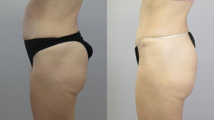 Tummy Tuck Case 1664 Before & After Left Side | Paramus, New Jersey | Parker Center for Plastic Surgery