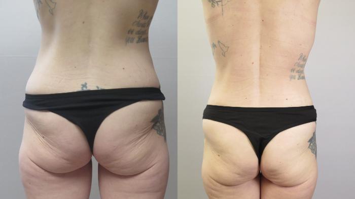 Tummy Tuck Case 1667 Before & After Back | Paramus, New Jersey | Parker Center for Plastic Surgery