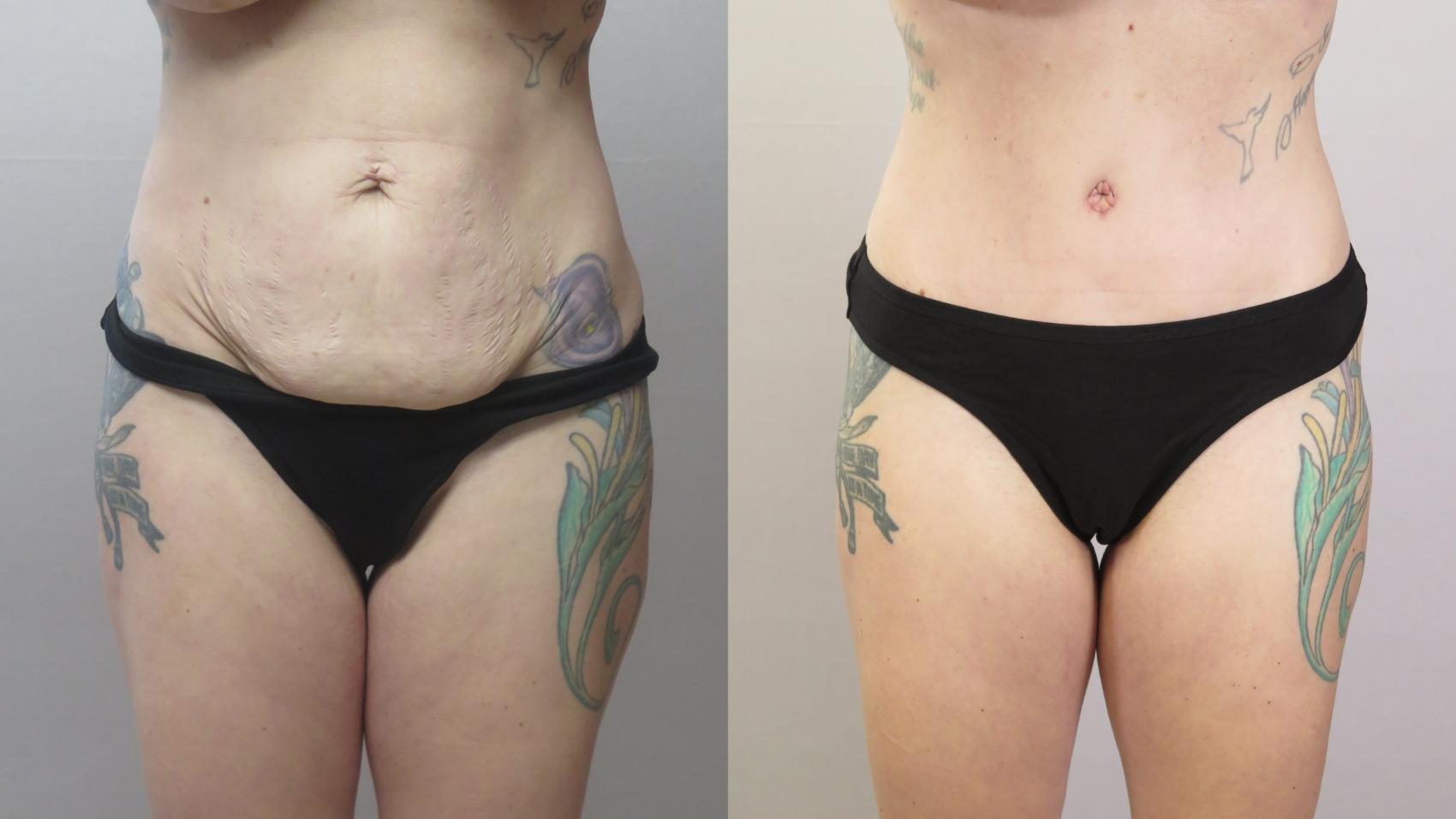 Tummy Tuck Case 1667 Before & After Front | Paramus, New Jersey | Parker Center for Plastic Surgery
