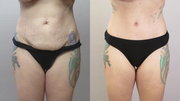 Tummy Tuck Case 1667 Before & After Front | Paramus, New Jersey | Parker Center for Plastic Surgery