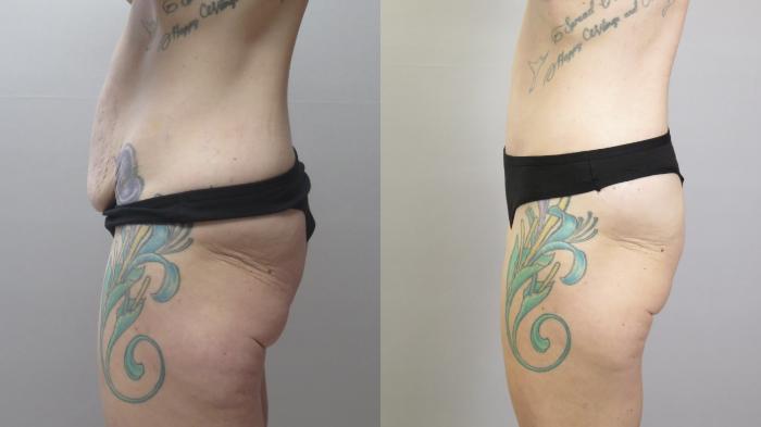 Tummy Tuck Case 1667 Before & After Left Side | Paramus, New Jersey | Parker Center for Plastic Surgery