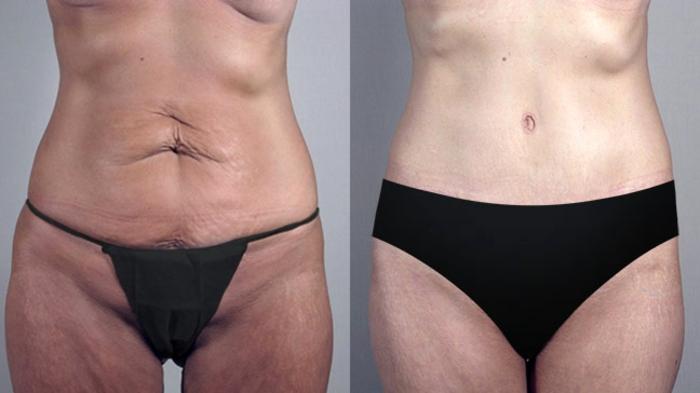 Tummy Tuck Case 555 Before & After View #1 | Paramus, New Jersey | Parker Center for Plastic Surgery
