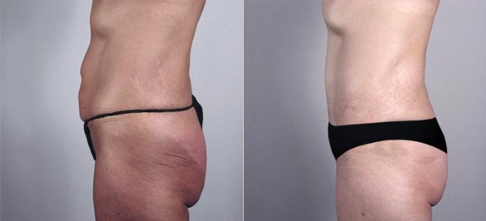 Tummy Tuck Case 555 Before & After View #2 | Paramus, New Jersey | Parker Center for Plastic Surgery