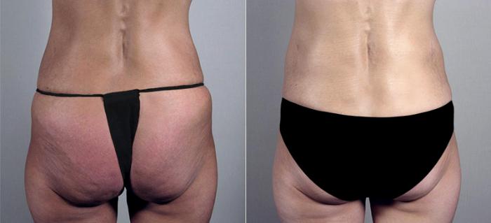 Tummy Tuck Case 555 Before & After View #3 | Paramus, New Jersey | Parker Center for Plastic Surgery