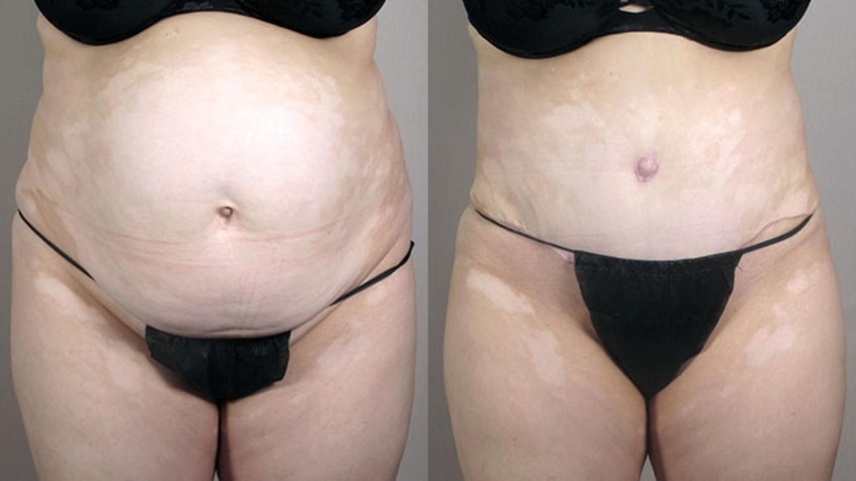 Tummy Tuck Case 557 Before & After View #1 | Paramus, New Jersey | Parker Center for Plastic Surgery