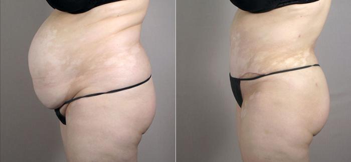 Tummy Tuck Case 557 Before & After View #2 | Paramus, New Jersey | Parker Center for Plastic Surgery