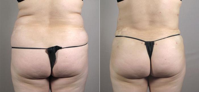 Tummy Tuck Case 557 Before & After View #3 | Paramus, New Jersey | Parker Center for Plastic Surgery