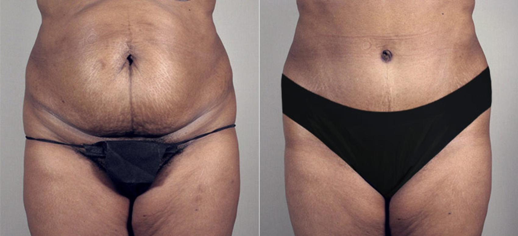 Tummy Tuck Case 686 Before & After View #2 | Paramus, New Jersey | Parker Center for Plastic Surgery
