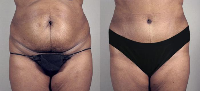 Tummy Tuck Case 686 Before & After View #2 | Paramus, New Jersey | Parker Center for Plastic Surgery