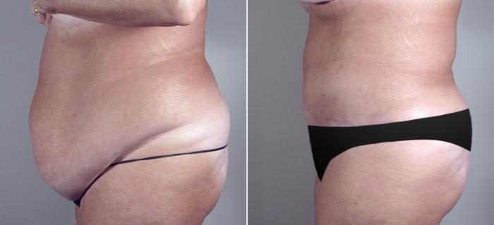 Tummy Tuck Case 687 Before & After View #2 | Paramus, New Jersey | Parker Center for Plastic Surgery