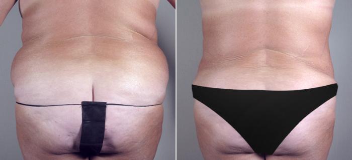 Tummy Tuck Case 687 Before & After View #3 | Paramus, New Jersey | Parker Center for Plastic Surgery