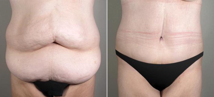 Tummy Tuck Case 688 Before & After View #1 | Paramus, New Jersey | Parker Center for Plastic Surgery