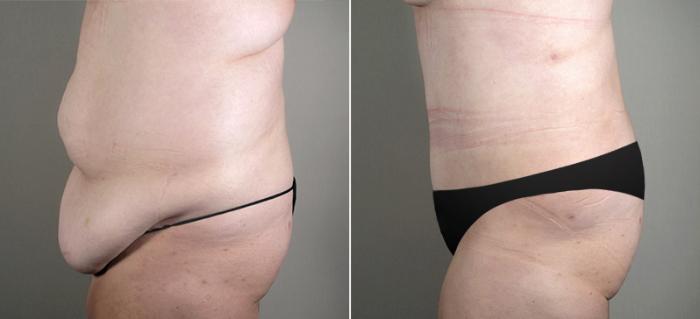Tummy Tuck Case 688 Before & After View #2 | Paramus, New Jersey | Parker Center for Plastic Surgery