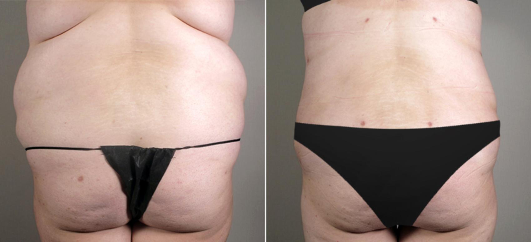 Tummy Tuck Case 688 Before & After View #3 | Paramus, New Jersey | Parker Center for Plastic Surgery