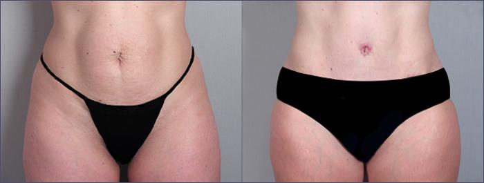 Tummy Tuck Case 690 Before & After View #1 | Paramus, New Jersey | Parker Center for Plastic Surgery