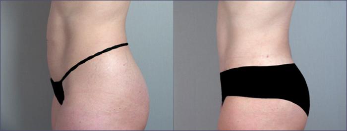 Tummy Tuck Case 690 Before & After View #2 | Paramus, New Jersey | Parker Center for Plastic Surgery