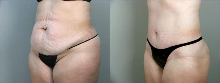 Tummy Tuck Case 692 Before & After View #2 | Paramus, New Jersey | Parker Center for Plastic Surgery