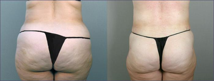 Tummy Tuck Case 692 Before & After View #3 | Paramus, New Jersey | Parker Center for Plastic Surgery
