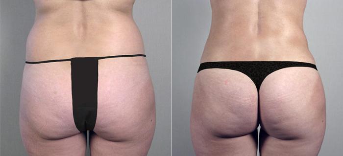 Liposuction Case 694 Before & After View #1 | Paramus, New Jersey | Parker Center for Plastic Surgery
