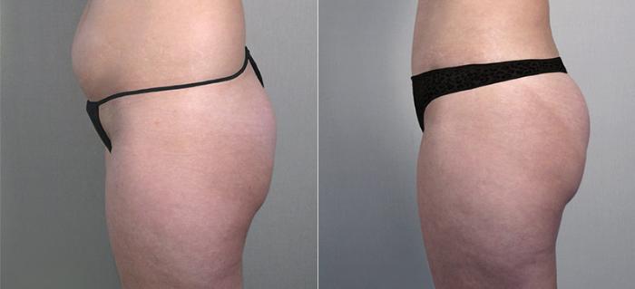 Liposuction Case 694 Before & After View #2 | Paramus, New Jersey | Parker Center for Plastic Surgery