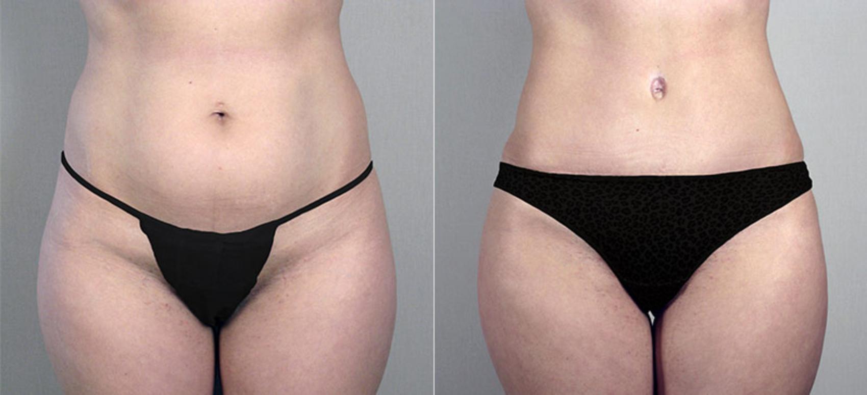 Tummy Tuck Case 694 Before & After View #3 | Paramus, New Jersey | Parker Center for Plastic Surgery