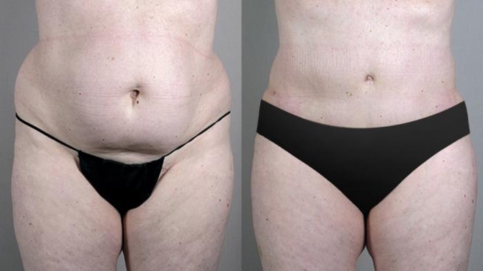 Liposuction Case 696 Before & After View #1 | Paramus, New Jersey | Parker Center for Plastic Surgery