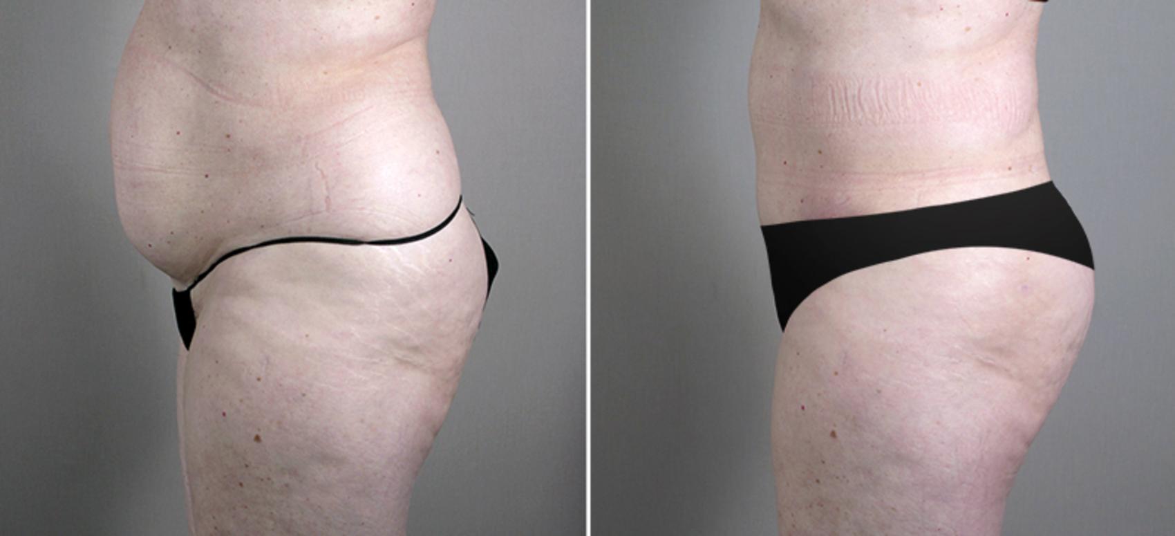 Tummy Tuck Case 696 Before & After View #2 | Paramus, New Jersey | Parker Center for Plastic Surgery