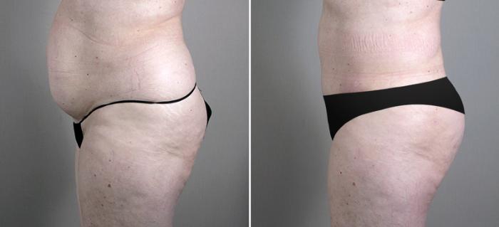 Liposuction Case 696 Before & After View #2 | Paramus, New Jersey | Parker Center for Plastic Surgery