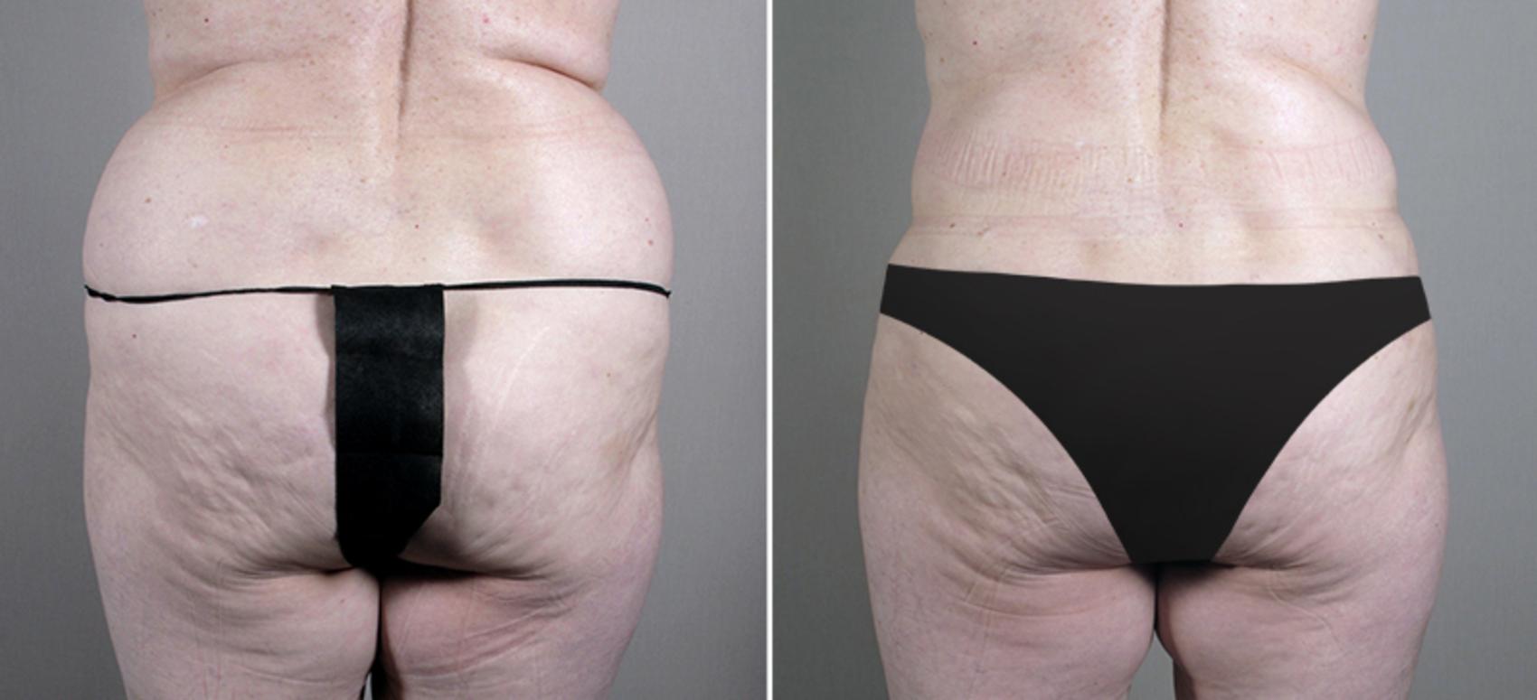 Tummy Tuck Case 696 Before & After View #3 | Paramus, New Jersey | Parker Center for Plastic Surgery