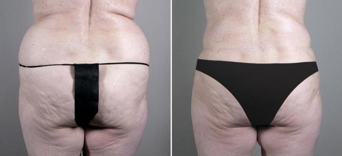 Liposuction Case 696 Before & After View #3 | Paramus, New Jersey | Parker Center for Plastic Surgery