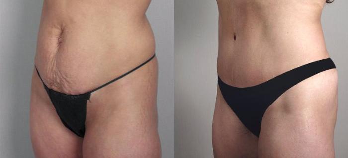 Liposuction Case 697 Before & After View #1 | Paramus, New Jersey | Parker Center for Plastic Surgery