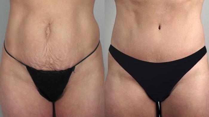 Liposuction Case 697 Before & After View #2 | Paramus, New Jersey | Parker Center for Plastic Surgery