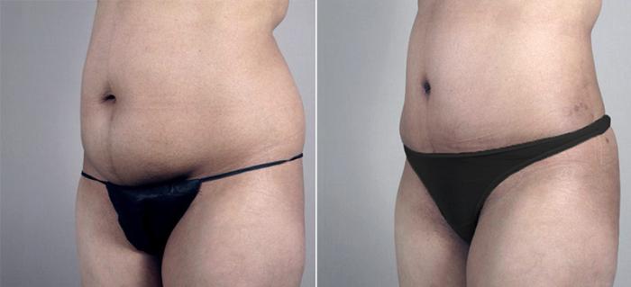 Tummy Tuck Case 698 Before & After View #2 | Paramus, New Jersey | Parker Center for Plastic Surgery