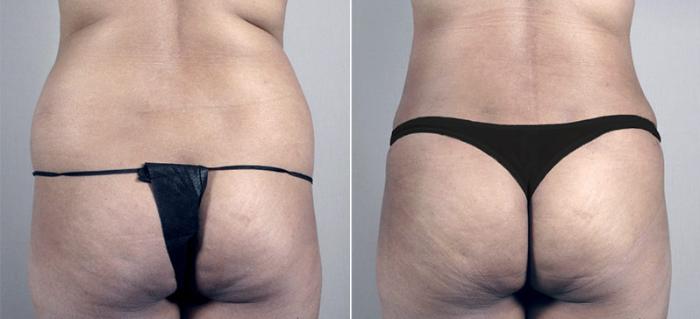 Tummy Tuck Case 698 Before & After View #3 | Paramus, New Jersey | Parker Center for Plastic Surgery