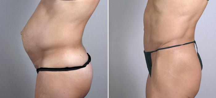 Tummy Tuck Case 699 Before & After View #2 | Paramus, New Jersey | Parker Center for Plastic Surgery