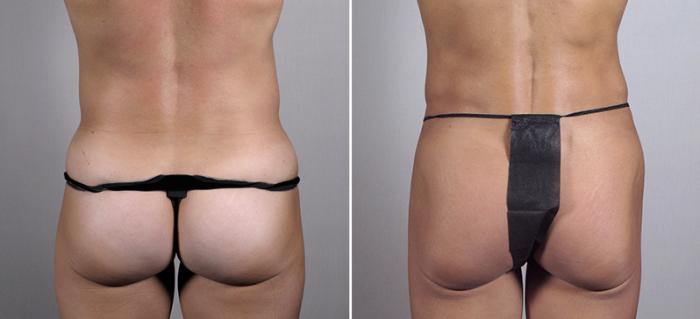 Tummy Tuck Case 699 Before & After View #3 | Paramus, New Jersey | Parker Center for Plastic Surgery