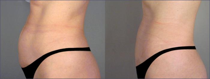 Tummy Tuck Case 700 Before & After View #2 | Paramus, New Jersey | Parker Center for Plastic Surgery