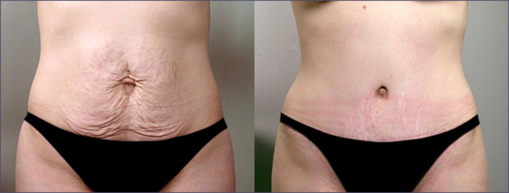 Tummy Tuck Case 701 Before & After View #1 | Paramus, New Jersey | Parker Center for Plastic Surgery