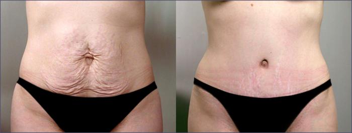 Tummy Tuck Case 701 Before & After View #1 | Paramus, New Jersey | Parker Center for Plastic Surgery